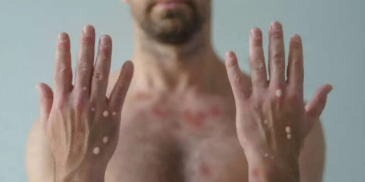 ভারতে মাঙ্কিপক্সের ভয়ানক ভ্যারিয়েন্ট ‘ক্লেড ১বি’ শনাক্ত