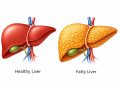 ওষুধ ছাড়াই ৩ উপায়ে কমবে ফ্যাটি লিভার