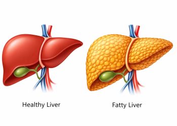 ওষুধ ছাড়াই ৩ উপায়ে কমবে ফ্যাটি লিভার