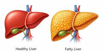 ওষুধ ছাড়াই ৩ উপায়ে কমবে ফ্যাটি লিভার
