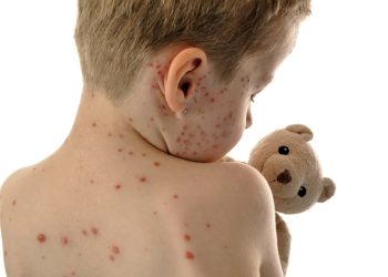 হাম হলে কী করবেন