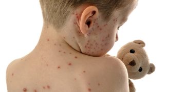 হাম হলে কী করবেন